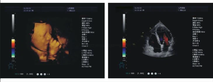 Trolley Color Doppler Ultrasound Machine