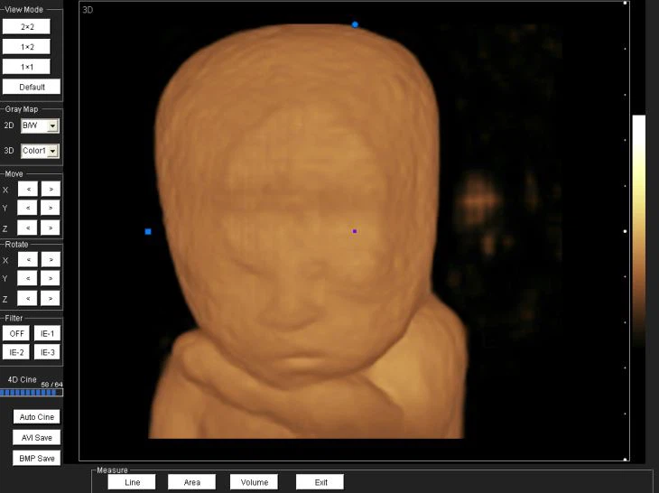 Trolley Baby Doppler Ultrasound Machine