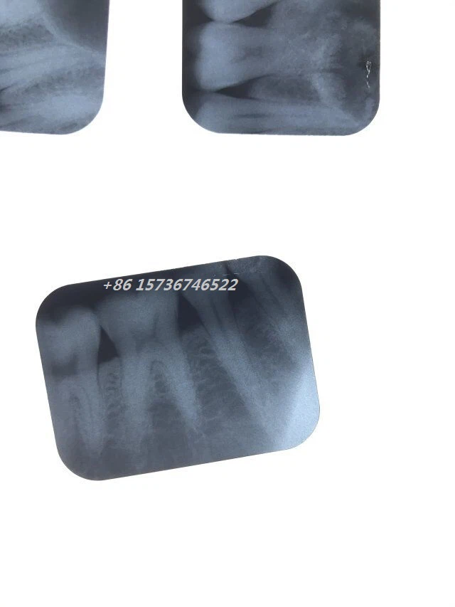 Portable Dental X Ra Unit